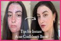 How To Feel Confident With Acne?
